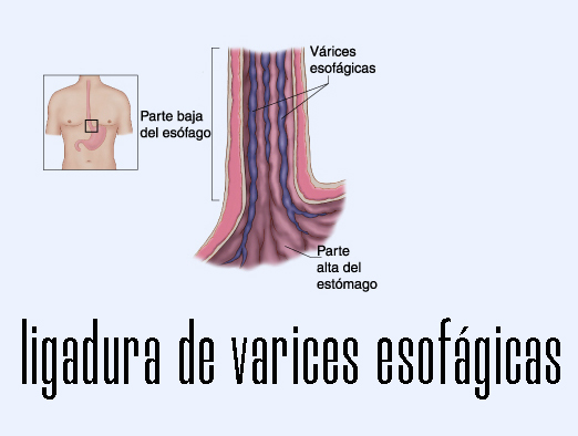 Várices-esofagicas ok